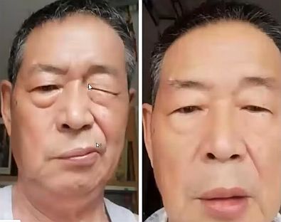 iTeraCare helps Bell's Palsy