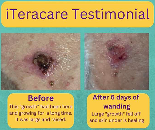 Healing from iTeraCare Wand