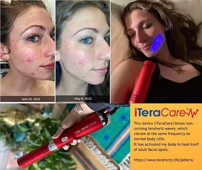 iTeracare helps pimples