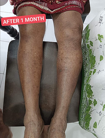 Diabetic with Varicose Veins
