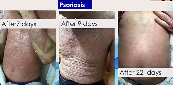 iTeraCare helps Psoriasis